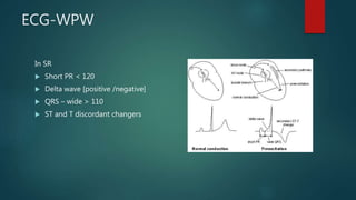 ECG-WPW
In SR
 Short PR < 120
 Delta wave [positive /negative]
 QRS – wide > 110
 ST and T discordant changers
 