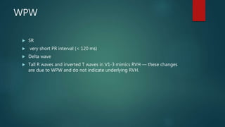 WPW
 SR
 very short PR interval (< 120 ms)
 Delta wave
 Tall R waves and inverted T waves in V1-3 mimics RVH — these changes
are due to WPW and do not indicate underlying RVH.
 