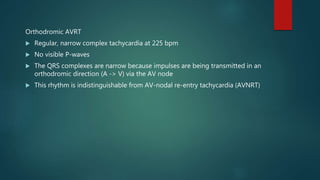 Orthodromic AVRT
 Regular, narrow complex tachycardia at 225 bpm
 No visible P-waves
 The QRS complexes are narrow because impulses are being transmitted in an
orthodromic direction (A -> V) via the AV node
 This rhythm is indistinguishable from AV-nodal re-entry tachycardia (AVNRT)
 