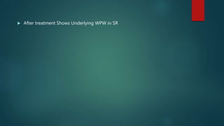  After treatment Shows Underlying WPW in SR
 