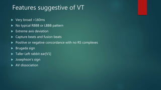 Features suggestive of VT
 Very broad >160ms
 No typical RBBB or LBBB pattern
 Extreme axis deviation
 Capture beats and fusion beats
 Positive or negative concordance with no RS complexes
 Brugada sign
 Taller Left rabbit ear[V1]
 Josephson’s sign
 AV dissociation
 