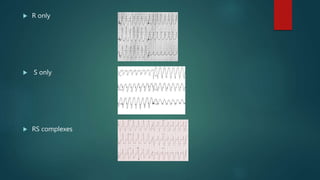  R only
 S only
 RS complexes
 