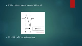  If RS complexes present measure RS interval
 RS > 100 – VT if not go to next step
 