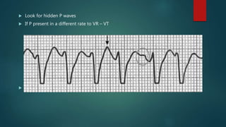  Look for hidden P waves
 If P present in a different rate to VR – VT
 If not go to next step
 