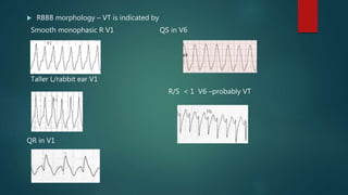  RBBB morphology – VT is indicated by
Smooth monophasic R V1 QS in V6
Taller L/rabbit ear V1
R/S < 1 V6 –probably VT
QR in V1
QR pattern V1
 