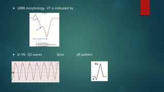  LBBB morphology- VT is indicated by
 In V6- QS waves &/or qR pattern
 