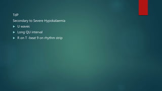 TdP
Secondary to Severe Hypokalaemia
 U waves
 Long QU interval
 R on T -beat 9 on rhythm strip
 