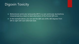 Digoxin Toxicity
 Bidirectional ventricular tachycardia (BVT) is a rare ventricular dysrhythmia
characterised by a beat-to-beat alternation of the frontal QRS axis.
 In the example above, you can see the QRS axis shifts 180 degrees from
left to right with each alternate beat.
 
