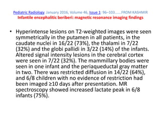 Pediatric Radiology. January 2016, Volume 46, Issue 1: 96–103…….FROM KASHMIR
Infantile encephalitic beriberi: magnetic resonance imaging findings
• Hyperintense lesions on T2-weighted images were seen
symmetrically in the putamen in all patients, in the
caudate nuclei in 16/22 (73%), the thalami in 7/22
(32%) and the globi pallidi in 3/22 (14%) of the infants.
Altered signal intensity lesions in the cerebral cortex
were seen in 7/22 (32%). The mammillary bodies were
seen in one infant and the periaqueductal gray matter
in two. There was restricted diffusion in 14/22 (64%),
and 6/8 children with no evidence of restriction had
been imaged ≥10 days after presentation. MR
spectroscopy showed increased lactate peak in 6/8
infants (75%).
 