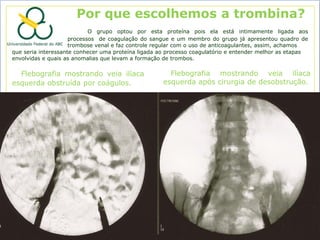 Por que escolhemos a trombina?
                            O grupo optou por esta proteína pois ela está intimamente ligada aos
                     processos de coagulação do sangue e um membro do grupo já apresentou quadro de
                     trombose venal e faz controle regular com o uso de anticoagulantes, assim, achamos
que seria interessante conhecer uma proteína ligada ao processo coagulatório e entender melhor as etapas
envolvidas e quais as anomalias que levam a formação de trombos.

  Flebografia mostrando veia ilíaca                    Flebografia mostrando veia ilíaca
esquerda obstruída por coágulos.                     esquerda após cirurgia de desobstrução.
 