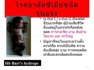 17
โรคธาลัสซีเมียชนิด
รุนแรง
Hb Bart’s hydropsHb Bart’s hydrops
• (a-thal 1 / a-thal 1) เป็นชนิด
ที่รุนแรงที่สุด ผู้ป่วยเสียชีวิต
ตั้งแต่อยู่ในครรภ์หรือหลังค
ลอด ทารกจะซีด บวม ตับม้าม
โตมาก และ รกใหญ่
• ปัญหาที่พบในแม่ระหว่างตั้ง
ครรภ์คือ ครรภ์เป็นพิษ ความ
ดันเลือดสูง บวม การคลอดผิด
ปกติและตกเลือดหลังคลอด
 