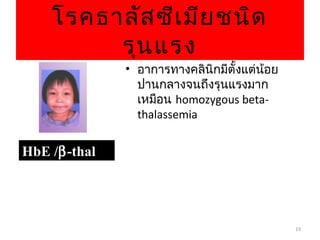 19
โรคธาลัสซีเมียชนิด
รุนแรง
HbEHbE //ββ-thal-thal
• อาการทางคลินิกมีตั้งแต่น้อย
ปานกลางจนถึงรุนแรงมาก
เหมือน homozygous beta-
thalassemia
 