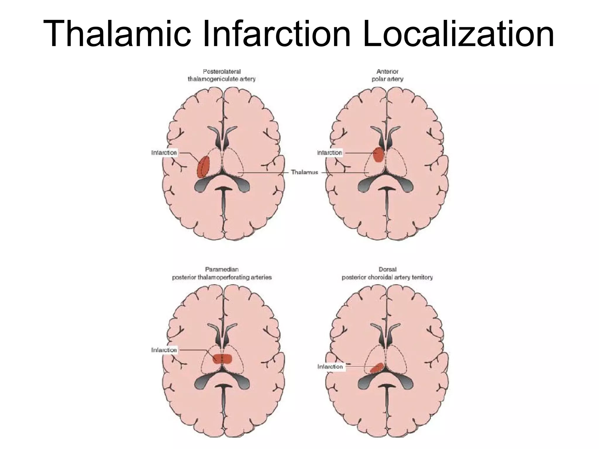 Thalamic Infarction Localization
 