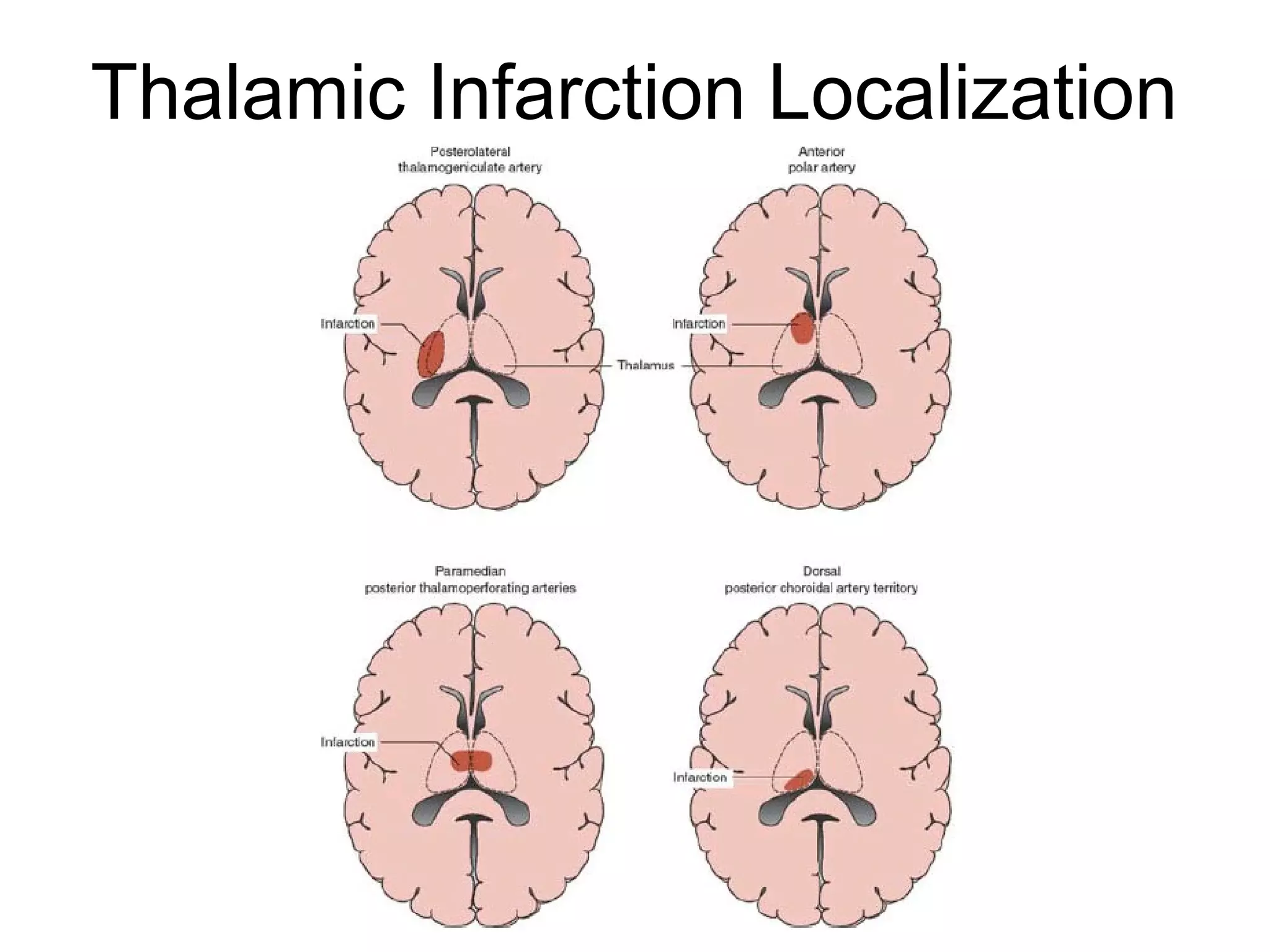 Thalamic Infarction Localization
 