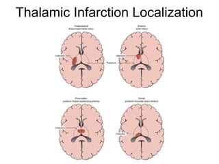 Thalamic Infarction Localization
 