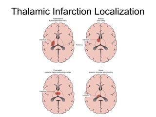 Thalamic Infarction Localization
 