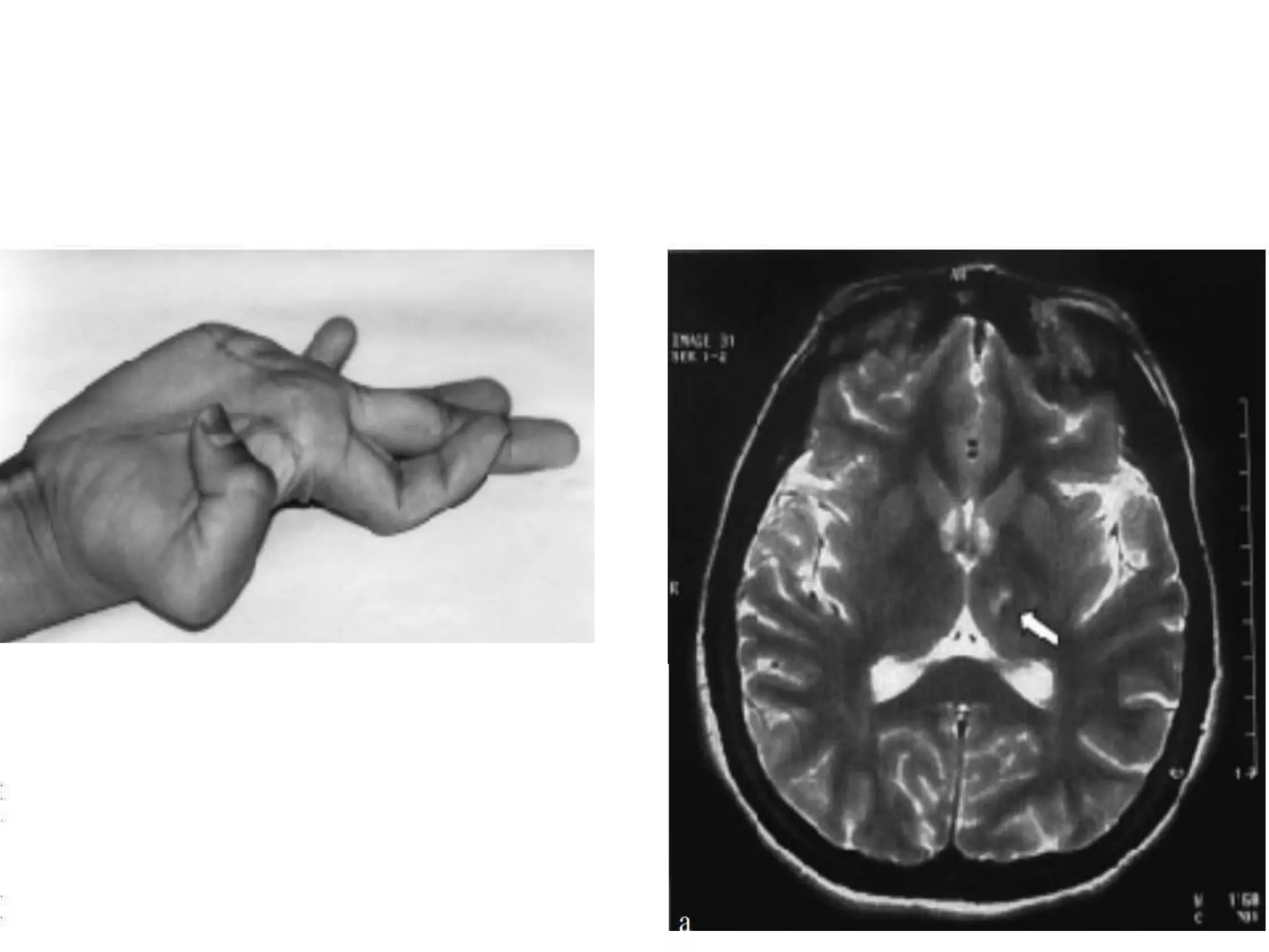Thalamus PPT