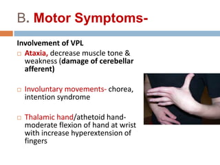 B. Motor Symptoms-
Involvement of VPL
 Ataxia, decrease muscle tone &
weakness (damage of cerebellar
afferent)
 Involuntary movements- chorea,
intention syndrome
 Thalamic hand/athetoid hand-
moderate flexion of hand at wrist
with increase hyperextension of
fingers
 