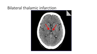Bilateral thalamic infarction
 