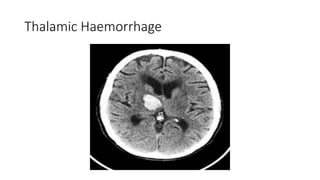 Thalamic Haemorrhage
 