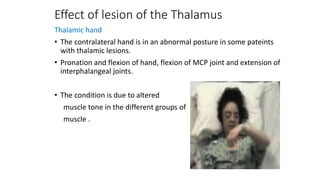 Effect of lesion of the Thalamus
Thalamic hand
• The contralateral hand is in an abnormal posture in some pateints
with thalamic lesions.
• Pronation and flexion of hand, flexion of MCP joint and extension of
interphalangeal joints.
• The condition is due to altered
muscle tone in the different groups of
muscle .
 
