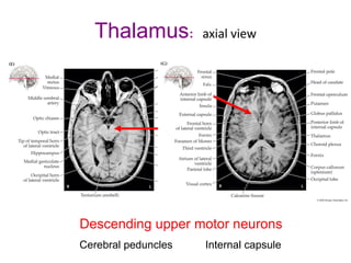 Thalamus: axial view
Descending upper motor neurons
Cerebral peduncles Internal capsule
 