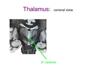 Thalamus: coronal view
3rd ventricle
 