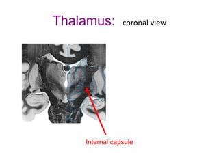 Thalamus: coronal view
Internal capsule
 