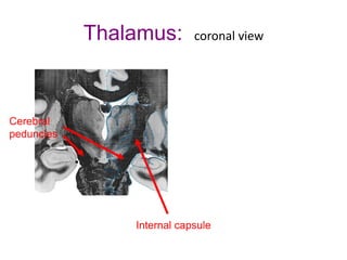 Thalamus: coronal view
Internal capsule
Cerebral
peduncles
 