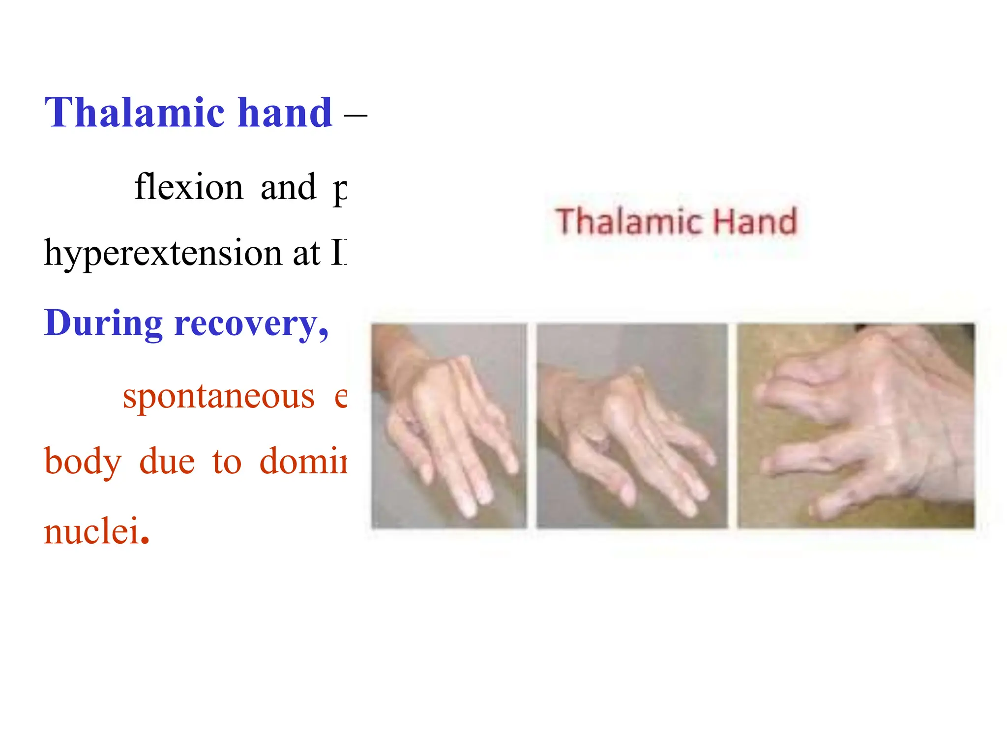 Thalamic hand –
flexion and pronation at wrist, flexion at MP joint,
hyperextension at IP joint.
During recovery,
spontaneous excruciating pain on opposite side of
body due to dominance of pain fibers ending on medial
nuclei.
 