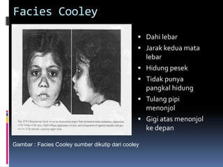 Facies Cooley
 Dahi lebar
 Jarak kedua mata
lebar
 Hidung pesek
 Tidak punya
pangkal hidung
 Tulang pipi
menonjol
 Gigi atas menonjol
ke depan
Gambar : Facies Cooley sumber dikutip dari cooley
 