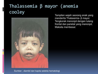 Tampilan wajah seorang anak yang
menderita Thalasemia- β mayor.
Tengkorak menonjol dengan tulang
frontal dan parietal yang menonjol;
Maksila membesar.
Thalassemia β mayor (anemia
cooley
Sumber : diambil dari kapita selekta hematologi
 