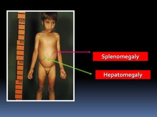 Hepatomegaly
Splenomegaly
 