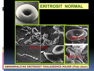 ERITROSIT NORMAL
Bizarre cells
Target cell
Poikilocyt
ABNORMALITAS ERITROSIT THALASSEMIA MAJOR (Foto skan)
 