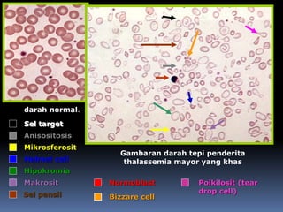 darah normal.
Gambaran darah tepi penderita
thalassemia mayor yang khas
Hipokromia
Anisositosis
Poikilosit (tear
drop cell)
Sel target
Bizzare cell
Normoblast
Helmet cell
Makrosit
Mikrosferosit
Sel pensil
 