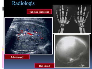 Radiologis
Trabekula tulang jelas
Hair on end
Splenomegaly
 
