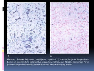 Gambar : thalasemia β mayor; biopsi jarum organ hati. (a) siderosis derajat IV dengan deposi
besi di sel parenkim hati, epitel duktus koleudokus, makrofag dan fibroblas (pewarnaan Perls).
(b) berkurangnya besi berlebih dalam hati setelah terapi khelasi yang intensif.
a b
 