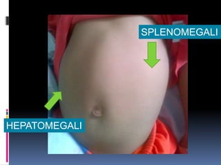 SPLENOMEGALI
HEPATOMEGALI
 