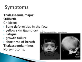 Thalassaemia major:
Stillbirth.
Children:
 Bone deformities in the face
 yellow skin (jaundice)
 Fatigue
 growth failure
 shortness of breath
Thalassaemia minor:
No symptoms.
 