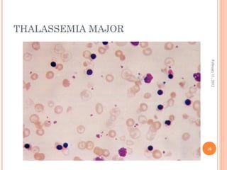 10
February11,2012
THALASSEMIA MAJOR
 