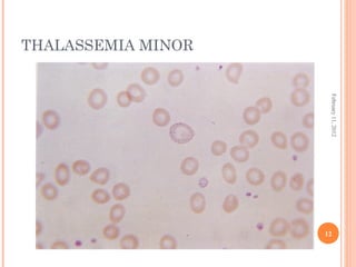 12
February11,2012
THALASSEMIA MINOR
 