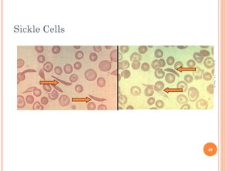 48
February11,2012
Sickle Cells
 