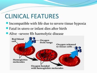 CLINICAL FEATURES
Incompatible with life due to severe tissue hypoxia
Fatal in utero or infant dies after birth
Alive –severe Rh haemolytic disease
 