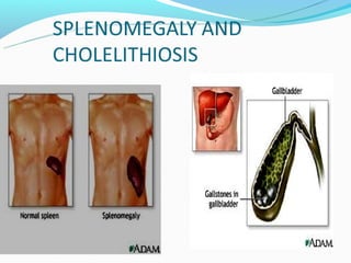  HEPATOSPLENOMEGA
  LY
 