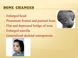 BONE CHANGES

 Enlarged head
 Prominent frontal and parietal bone

 Flat and depressed bridge of nose

 Enlarged maxilla

 Generalized skeletal osteoporosis
 