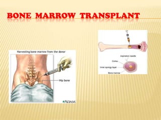 BONE MARROW TRANSPLANT
 
