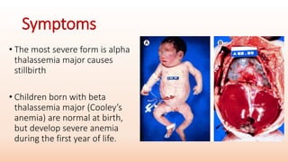 Symptoms
• The most severe form is alpha
thalassemia major causes
stillbirth
• Children born with beta
thalassemia major (Cooley’s
anemia) are normal at birth,
but develop severe anemia
during the first year of life.
 