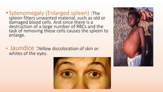 •Splenomegaly (Enlarged spleen) :The
spleen filters unwanted material, such as old or
damaged blood cells. And since there is a
destruction of a large number of RBCs and the
task of removing these cells causes the spleen to
enlarge.
• Jaundice :Yellow discoloration of skin or
whites of the eyes.
 
