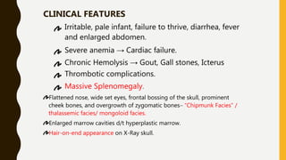 CLINICAL FEATURES
Irritable, pale infant, failure to thrive, diarrhea, fever
and enlarged abdomen.
Severe anemia → Cardiac failure.
Chronic Hemolysis → Gout, Gall stones, Icterus
Thrombotic complications.
Massive Splenomegaly.
Flattened nose, wide set eyes, frontal bossing of the skull, prominent
cheek bones, and overgrowth of zygomatic bones– “Chipmunk Facies” /
thalassemic facies/ mongoloid facies.
Enlarged marrow cavities d/t hyperplastic marrow.
Hair-on-end appearance on X-Ray skull.
 