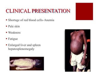 CLINICAL PRESENTATION
 Shortage of red blood cells-Anemia
 Pale skin
 Weakness
 Fatigue
 Enlarged liver and spleen
hepatosplenomegaly
 